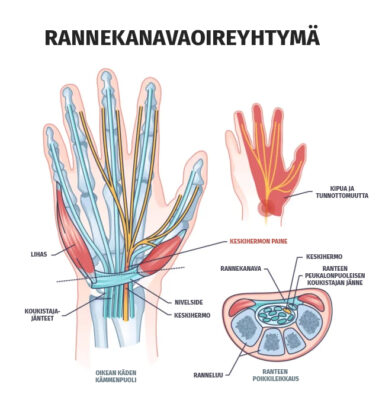 Lääketieteellinen graafinen kuva rannekanavaoireyhtymästä